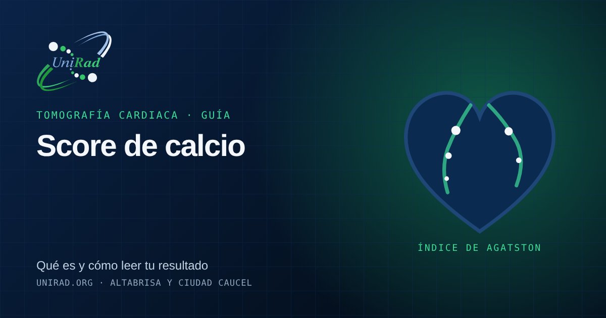 Ilustración de un corazón con puntos de calcio en las arterias coronarias